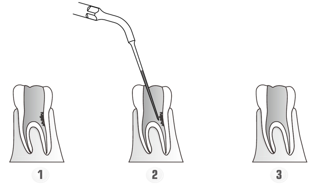 Сфера применения наконечника для скалера